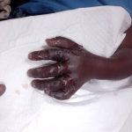 Mother recalls tragic child limb amputation