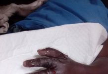 Mother recalls tragic child limb amputation