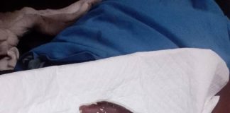 Mother recalls tragic child limb amputation