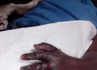 Mother recalls tragic child limb amputation