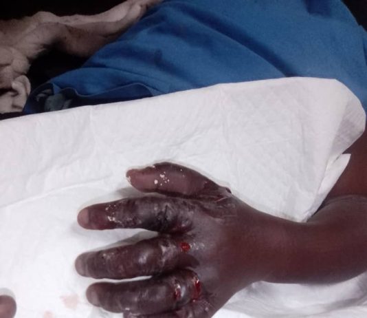 Mother recalls tragic child limb amputation